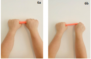 x2 pictures showing Ulnar Deviation
