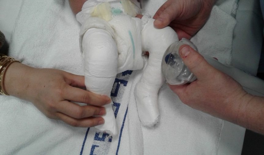 Leg cast on a baby being removed with a special cast saw