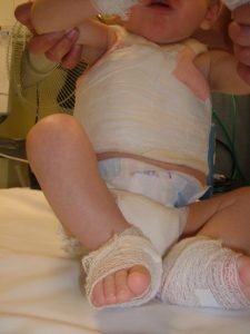 baby in a cast 