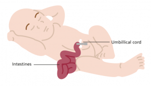 Illustration of baby with intestines hanging out of belly button