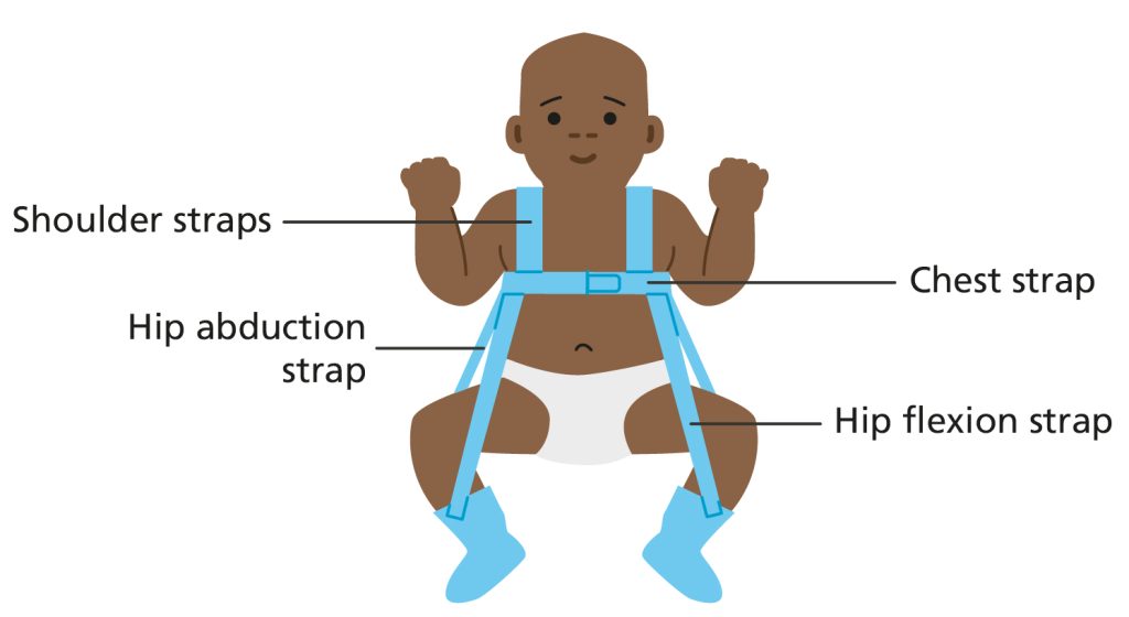 Illustration of baby in a Pavlik harness where their feet are held in place with a chest strap