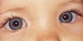Image of child's eyes with Pseudostrabismus