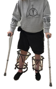 Photograph of person stood up walking using walking aids and with their legs in leg frames