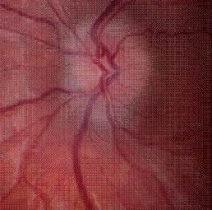 Normal optic nerve head with crisp margins to the disc