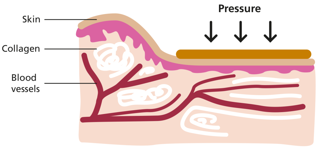 Illustration of diagram of pressure garment being used on skin to help a burns wound heal