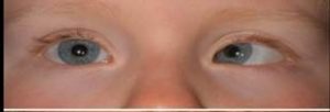 Image of child's eyes without glasses with left eye turning inwards while right eye looks straight ahead