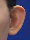 Photo showing prominent ears before surgical correction