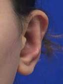 Photo showing prominent ears after surgical correction