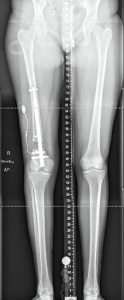 Photograph of X-ray of someone's lower body from the front showing their legs and hips with electrical equipment attached to thigh