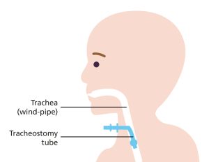 Illustration diagram of tracheostomy in child's throat