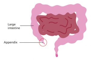Illustration of intestines and inflamed appendix