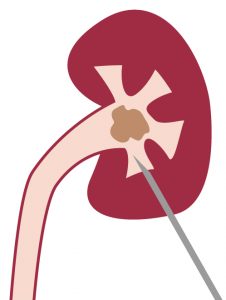Illustration of kidney with a needle going in to puncture a kidney stone