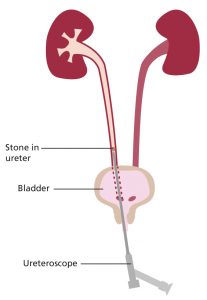 Illustration of a small ureteroscope going up urethra and into the bladder, then into the ureter to break apart kidney stone
