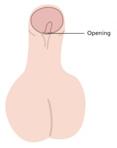 Illustration of penis with a mild hypospadias, where the wee hole is slightly below where it should be