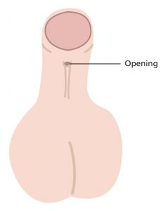 Illustration of penis with a moderate hypospadias, where the wee hole is quite far down below where it should be