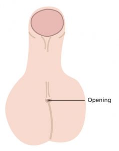 Illustration of penis with a severe hypospadias, where the wee hole is at the base of the penis