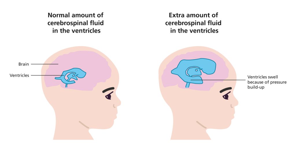 Illustration of brain inside child's head where the cerebrospinal fluid has built up in the ventricles compared to a normal brain