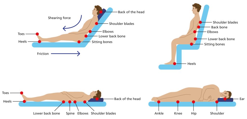 Illustration showing areas of concern when sitting down, reclined, laid down on back, and laid on side
