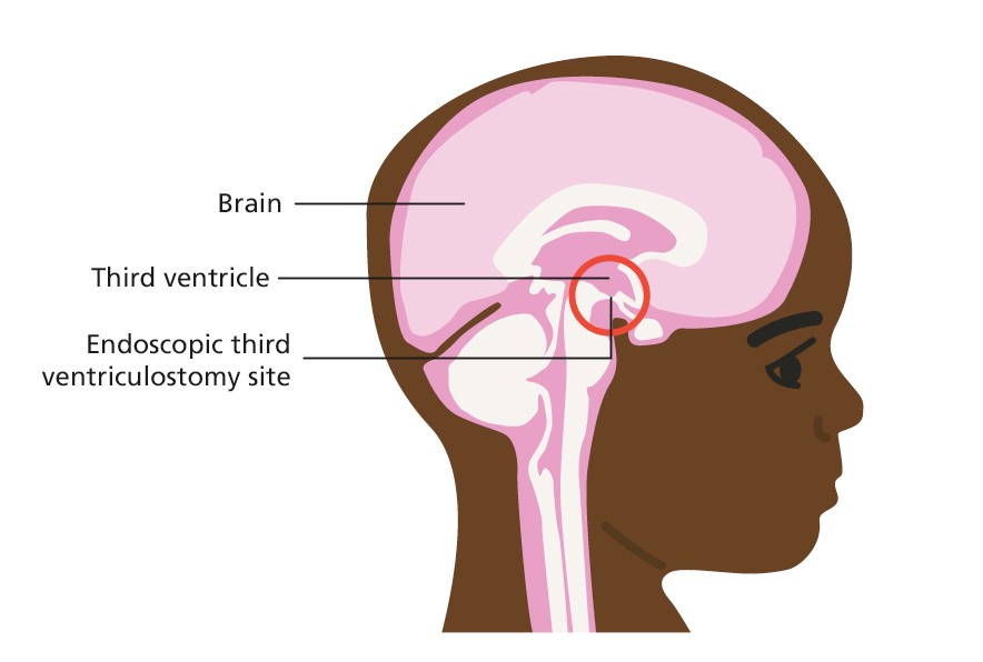 Illustration of child's head and brain showing where the endoscopic third ventriculostomy site is