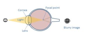Diagram of myopia eye with a blurry image