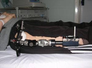 image of hip distraction fixator, without the ‘night-time’ extension strut
